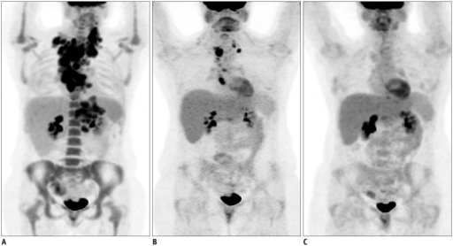 FDG PET/CT showing diffuse large B-cell lymphoma with multiple hypermetabolic lymph nodes and treatment response