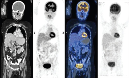 FDG PET/CT showing bilateral symmetric brown fat activation in the cervical and supraclavicular regions