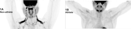 Whole-body F-18 FDG PET/CT maximum intensity projection (MIP) image