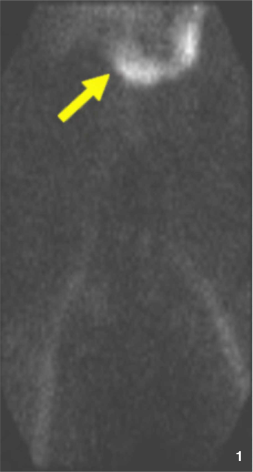 Tc-99m labeled RBC scan showing active extravasation of radiotracer into the bowel lumen indicating gastrointestinal bleeding