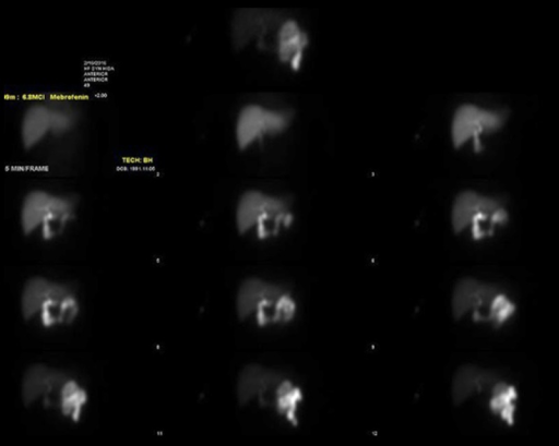 HIDA scan showing non-visualization of the gallbladder consistent with acute cholecystitis