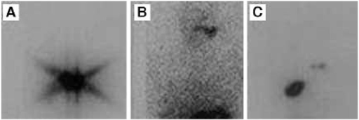 Post-therapy I-131 whole-body scan showing thyroid bed uptake and distant metastatic foci in differentiated thyroid cancer
