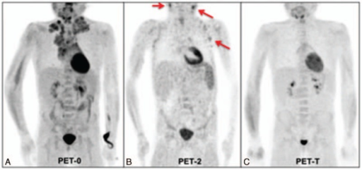 Serial FDG PET/CT scans showing interim and end-of-treatment response in Hodgkin lymphoma using the Deauville scoring system
