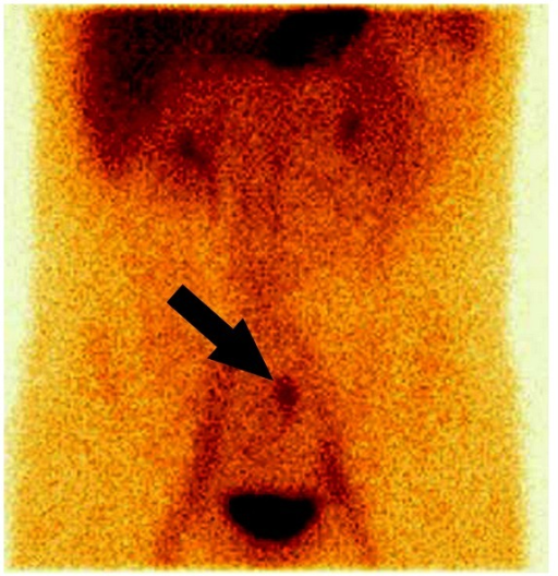 Tc-99m pertechnetate scan showing focal uptake in the right lower quadrant consistent with a Meckel diverticulum containing ectopic gastric mucosa
