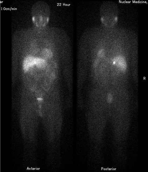 I-123 MIBG whole-body scan showing focal adrenal uptake in a patient with pheochromocytoma