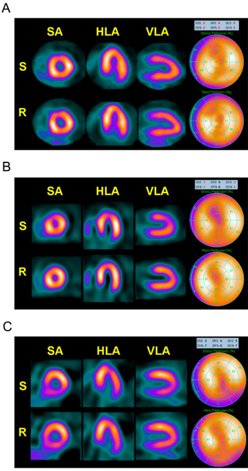 Myocardial perfusion SPECT images showing stress and rest perfusion with normal and reversible defect patterns