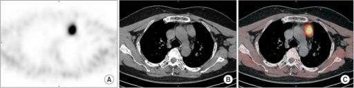 Sestamibi SPECT/CT showing an ectopic mediastinal parathyroid adenoma