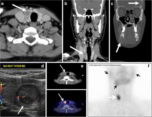 Tc-99m sestamibi SPECT/CT demonstrating a parathyroid adenoma with persistent focal uptake on delayed images