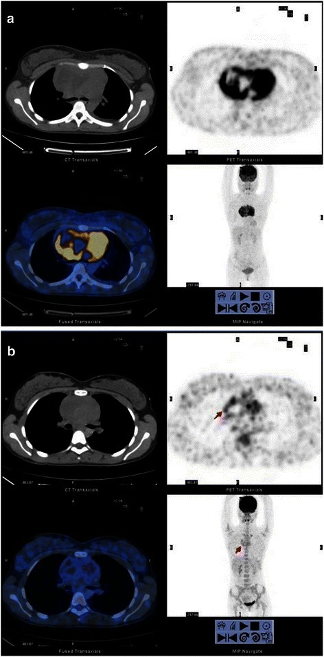 PSMA PET/CT showing multiple PSMA-positive metastatic lesions in a patient with prostate cancer recurrence