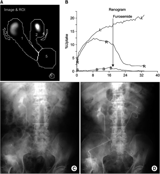 Tc-99m MAG3 diuretic renogram showing renal uptake curves and regions of interest over both kidneys