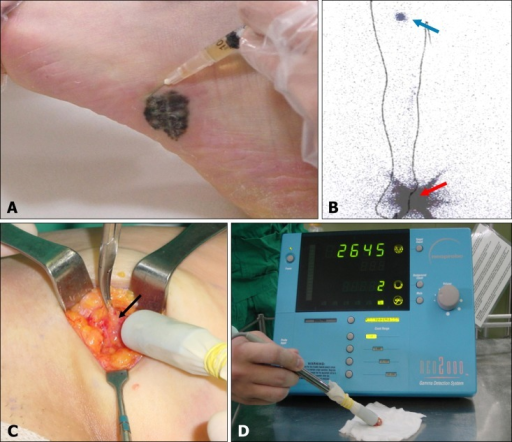 Lymphoscintigraphy-guided sentinel lymph node biopsy showing tracer injection, drainage pathway mapping, and intraoperative gamma probe localization