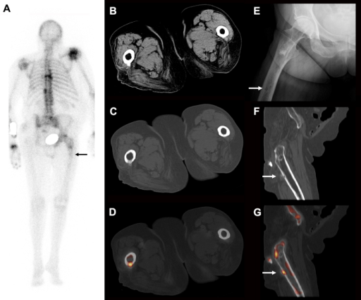 Three-phase bone scan showing flow, blood pool, and delayed phases in the evaluation of a musculoskeletal lesion