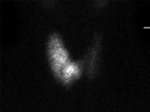 Thyroid scintigraphy showing a hyperfunctioning hot nodule with suppression of surrounding thyroid tissue
