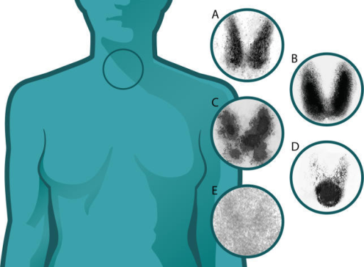 Thyroid scintigraphy showing five different uptake patterns including normal, Graves disease, toxic nodule, and thyroiditis