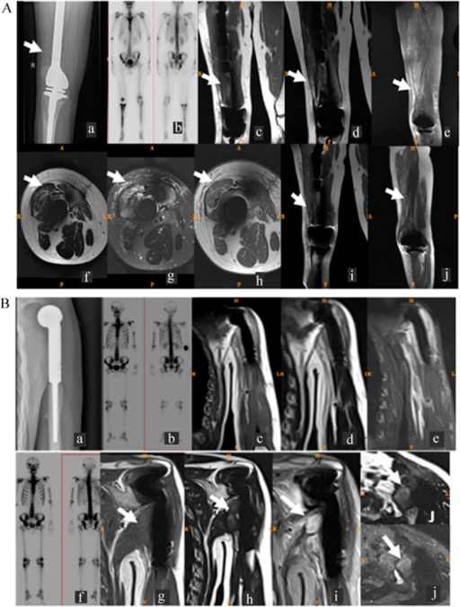 Ventilation-perfusion scan and related imaging showing perfusion defects in the evaluation of pulmonary embolism
