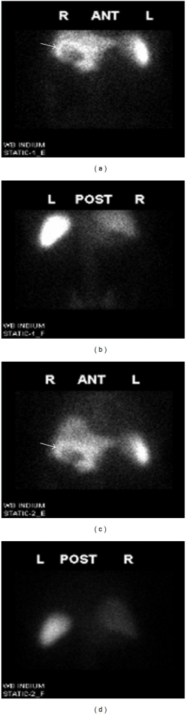 Labeled white blood cell scan showing abnormal accumulation at an infection site with normal liver and spleen uptake