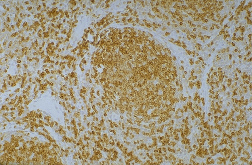 BCL-2 immunohistochemistry in follicular lymphoma showing positive brown staining in neoplastic follicles
