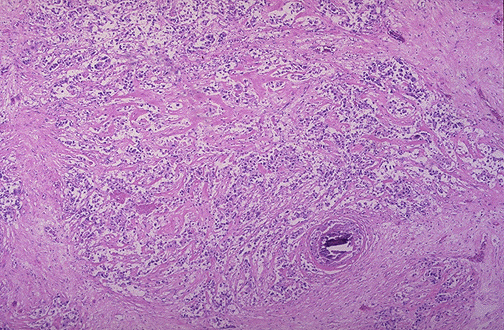 Infiltrating ductal carcinoma of breast showing irregular nests of tumor cells in desmoplastic stroma at low magnification