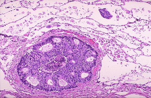 Breast carcinoma metastatic to lung with lymphangitic spread showing tumor cells in lymphatic channels