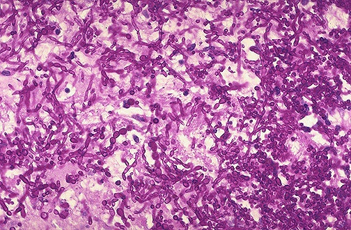 PAS stain showing magenta-stained Candida organisms with pseudohyphae in lung tissue