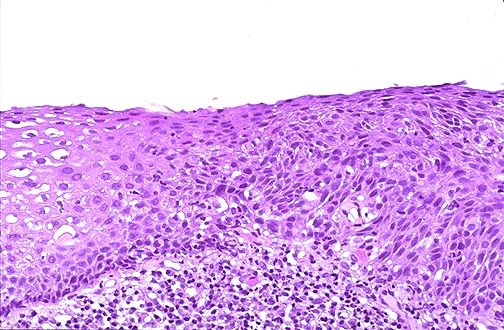 Cervical intraepithelial neoplasia showing dysplastic squamous epithelium compared to normal epithelium