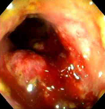 Colonic adenocarcinoma as seen on endoscopy showing an ulcerated mass in the colon
