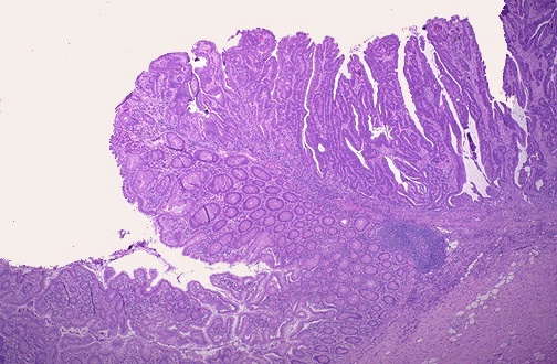 Colonic adenocarcinoma at low magnification showing invasive malignant glands infiltrating through bowel wall