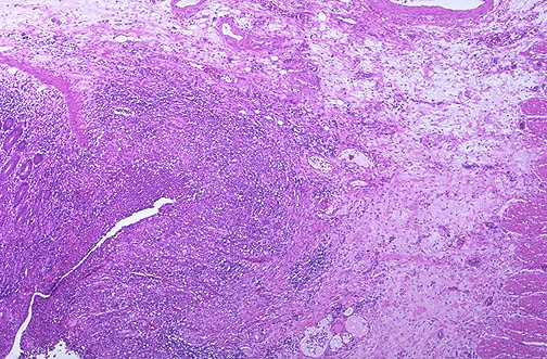 Crohn disease showing non-caseating granuloma in intestinal wall with epithelioid histiocytes