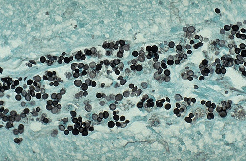 GMS stain showing black-stained Cryptococcus neoformans organisms with surrounding clear halos