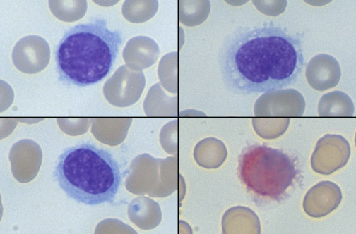 Hairy cell leukemia with tartrate-resistant acid phosphatase (TRAP) stain showing positive red cytoplasmic staining