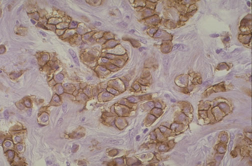 HER2 immunohistochemistry showing brown membrane staining in breast carcinoma cells