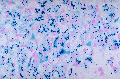 Prussian blue iron stain showing blue hemosiderin granules in liver hepatocytes