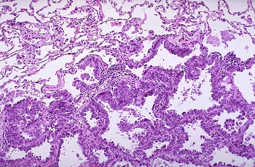 Lung adenocarcinoma in situ showing lepidic growth along alveolar walls without stromal invasion