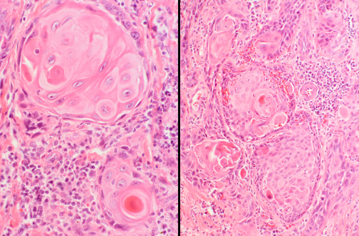 Lung squamous cell carcinoma showing keratinizing nests of tumor cells with intercellular bridges