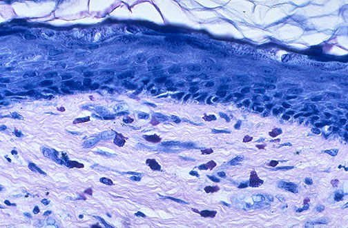 Giemsa stain showing purple metachromatic mast cell granules in dermis