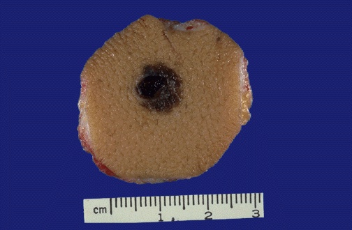 Cutaneous melanoma gross photograph showing asymmetric pigmented lesion with irregular borders and color variation