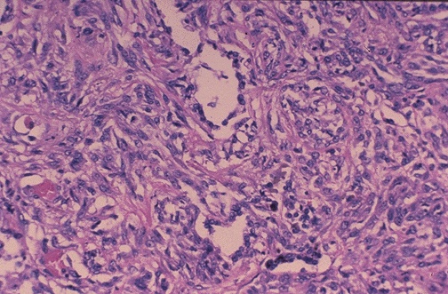 Malignant mesothelioma showing epithelioid tumor cells with tubulopapillary architecture
