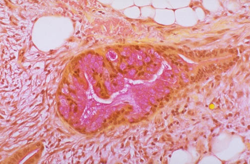 Mucicarmine stain showing deep rose-colored mucin in colonic adenocarcinoma