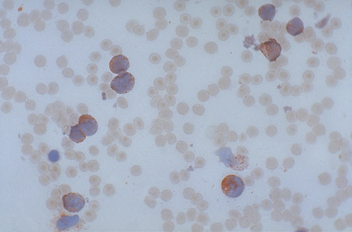 Myeloperoxidase cytochemical stain showing red reaction product in myeloid blasts of acute myeloid leukemia