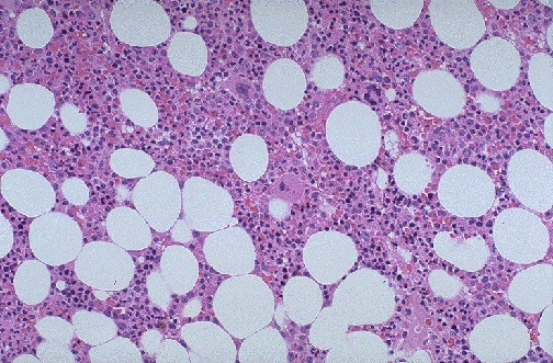 Normal bone marrow biopsy showing trilineage hematopoiesis with appropriate cellularity and fat spaces