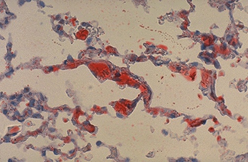 Oil Red O stain showing red lipid droplets in lung tissue with fat emboli
