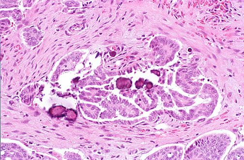 Ovarian serous carcinoma showing concentric laminated calcified psammoma bodies among tumor cells