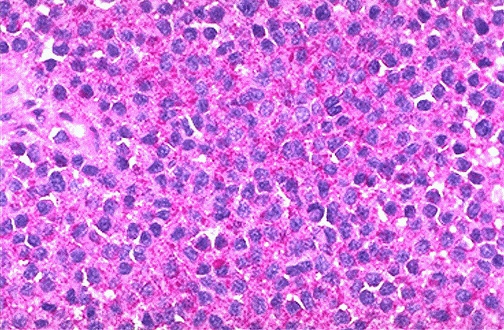 PAS stain of Ewing sarcoma showing glycogen-positive small round blue cells