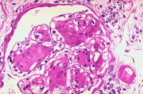 PAS stain of kidney showing nodular glomerulosclerosis with thickened basement membranes