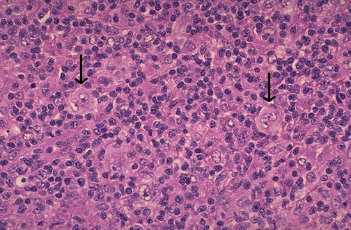 Reed-Sternberg cells in Hodgkin lymphoma showing large binucleated cells with prominent nucleoli in reactive inflammatory background