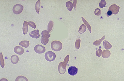 Sickle cell disease peripheral blood smear showing elongated crescent-shaped red blood cells