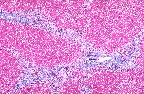 Masson trichrome stain of liver showing blue collagen fibrosis bands in chronic hepatitis