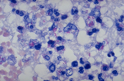 Ziehl-Neelsen acid-fast stain showing red Mycobacterium tuberculosis bacilli on blue background