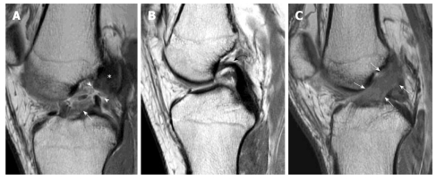 MRI showing primary signs of ACL tear including fiber discontinuity and edematous changes