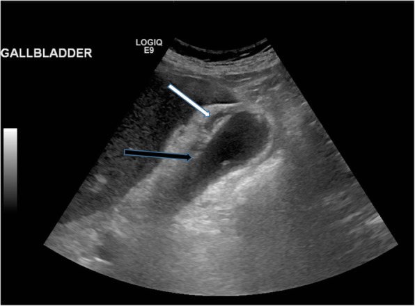 Ultrasound showing acute cholecystitis with gallstones, wall thickening, and pericholecystic fluid